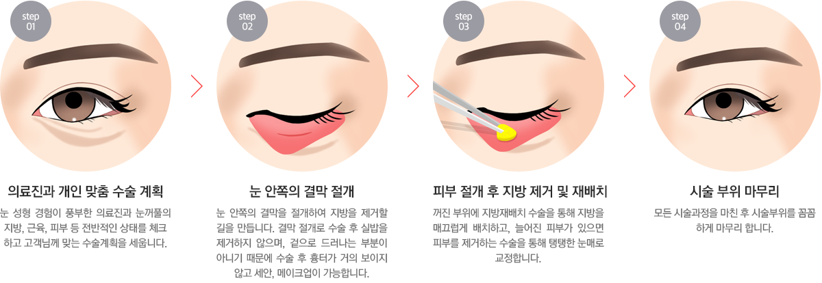 눈밑성형